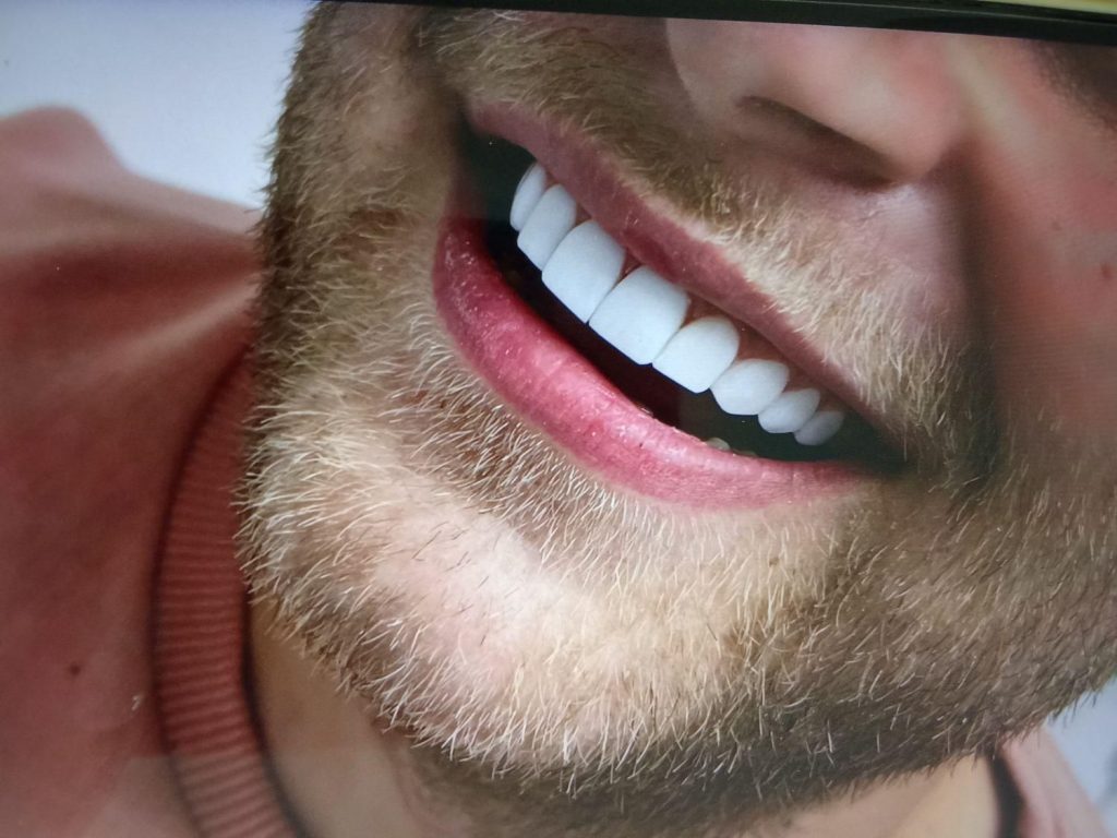 کامپوزیت دندان و عصب کشی و لمینت روکش