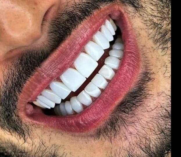 کامپوزیت دندان و دندانپزشکی و ایمپلنت و درمانی